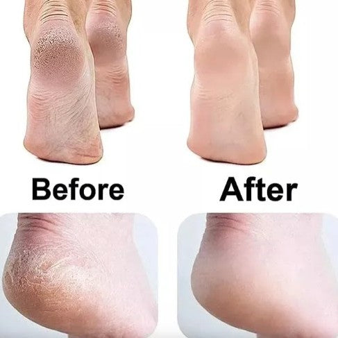 REMOVEDOR DE CALLO BD613